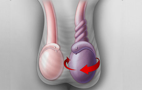 پیچ خوردگی بیضه